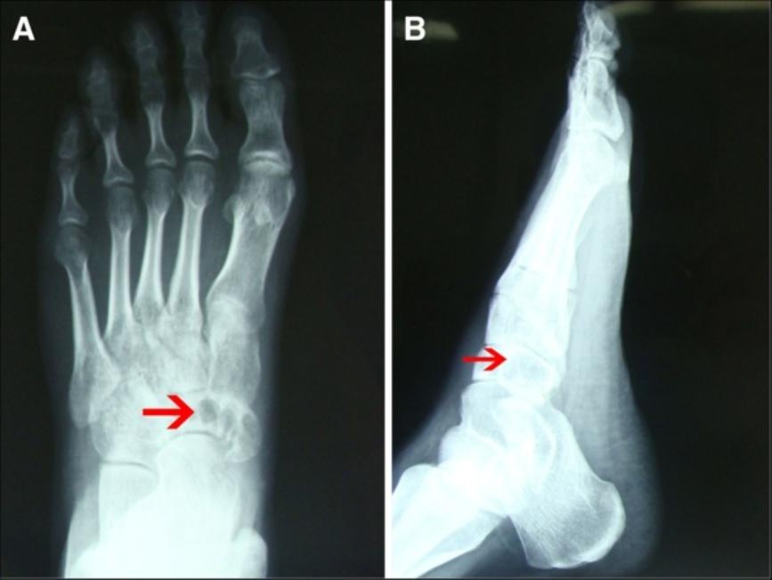 Fang and Chen World Journal of Surgical Oncology 2013, 11:50 Page 2 of 6 Figure 1 Radiographs of the patient s left foot.