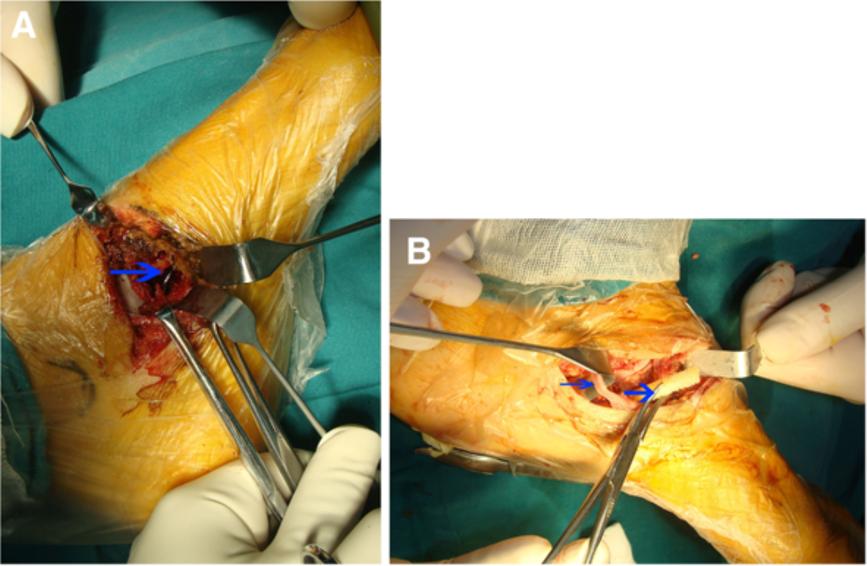 Fang and Chen World Journal of Surgical Oncology 2013, 11:50 Page 3 of 6 Figure 3 Interoperative photographs.