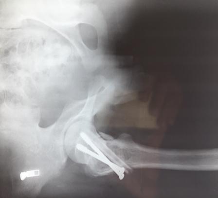 Radiograph of a case of aneurysmal bone cyst (17/M) of right proximal