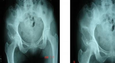 this minimally invasive method is able to promote the selfhealing of a primary aneurysmal bone cyst.