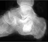 treating periarticular fractures.