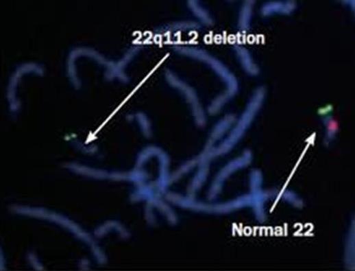 Fluorescent In Situ Hybridization (FISH) Specially designed fluorescent probes that hybridize to metaphase or interphase