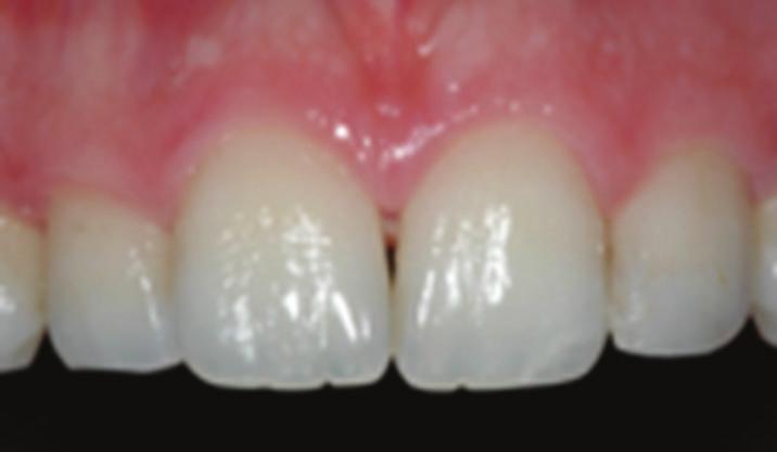 TypeII: the dimension of the gingiva from the gingival margin to the mucogingival junction appears normal.