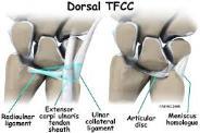 TFCC Midcarpal Joint Triangular Fibrocartilage Complex