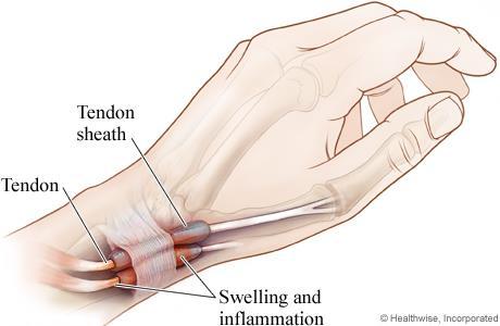 De Quervian s Tenosynovitis - Anatomy Thumbs were not designed for forceful, repetitive motions; they were designed to stabilize Tendons connect muscle to bone. Muscles pull on tendons for movement.