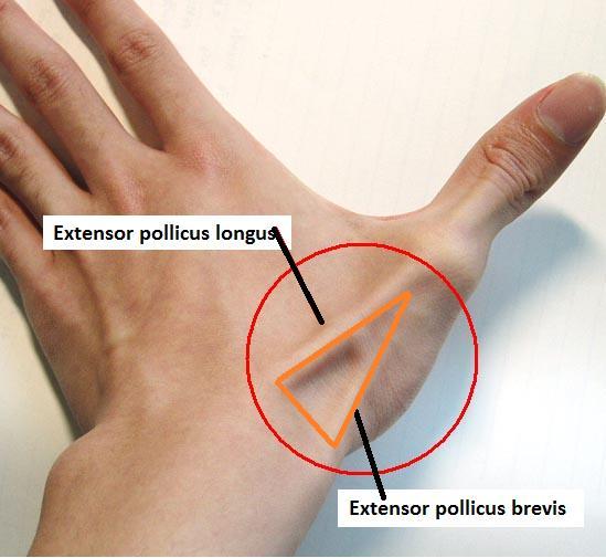 De Quervian s Tenosynovitis - Symptoms Symptoms: Primary symptoms consist of pain, tenderness, or swelling over the thumb side of the wrist in the area of the anatomic snuffbox.