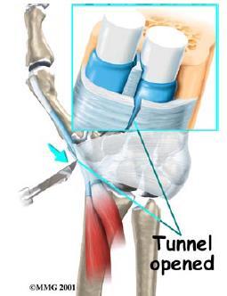 De Quervian s Tenosynovitis - Treatment Surgical Goal of surgery is to give the tendons more space so that they no longer rub on the inside of the tunnel.