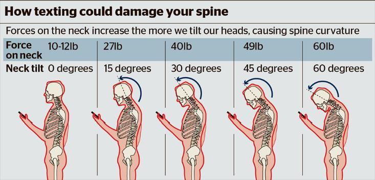 Text Neck Increases forces on the cervical spine 45 degrees is typical when texting Stretching your tissue for long periods of time causes