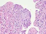 Pathology and 1988 in Chest): Fibroblast foci are recognized and