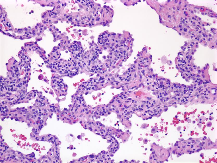 Nonspecific Interstitial Pneumonia Histologic Criteria chronic interstitial pneumonia with ( fibrotic NSIP ) or without ( cellular NSIP )