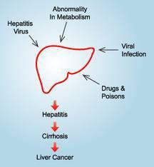 Common Diseases of Liver HEPATITIS: Inflamation of Liver caused due to Viral Infections.