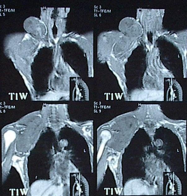 Patient Figure 3-a: MRI