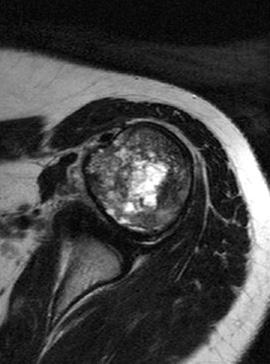 222 Fig. 3. (A) Prechemotherapy T2 magnetic resonance imaging of proximal humeral osteosarcoma shows intra-compartmental lesion.