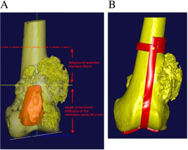 Ding et al. BMC Musculoskeletal Disorders 2013, 14:331 Page 5 of 9 Figure 2 Measurement and resection of tumor region.