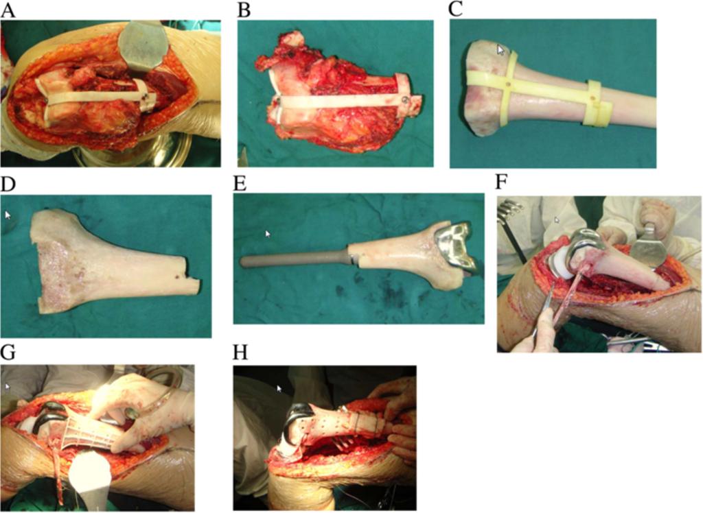 Ding et al. BMC Musculoskeletal Disorders 2013, 14:331 Page 7 of 9 Figure 4 Intraoperative photos. A) Auxiliary template for tumor resection was installed. B) Resected specimen.