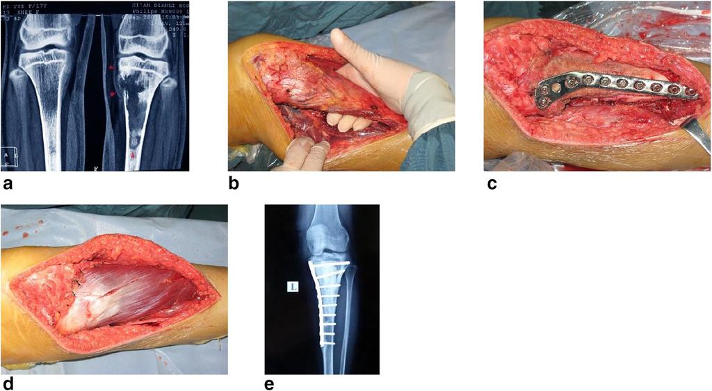 Page 4 of 6 Fig. 2 Typical procedure for osteosarcoma at proximal tibia. a X-ray film before surgery. b Isolation of tumor bone. c Give a prophylactic fixation after MWA.
