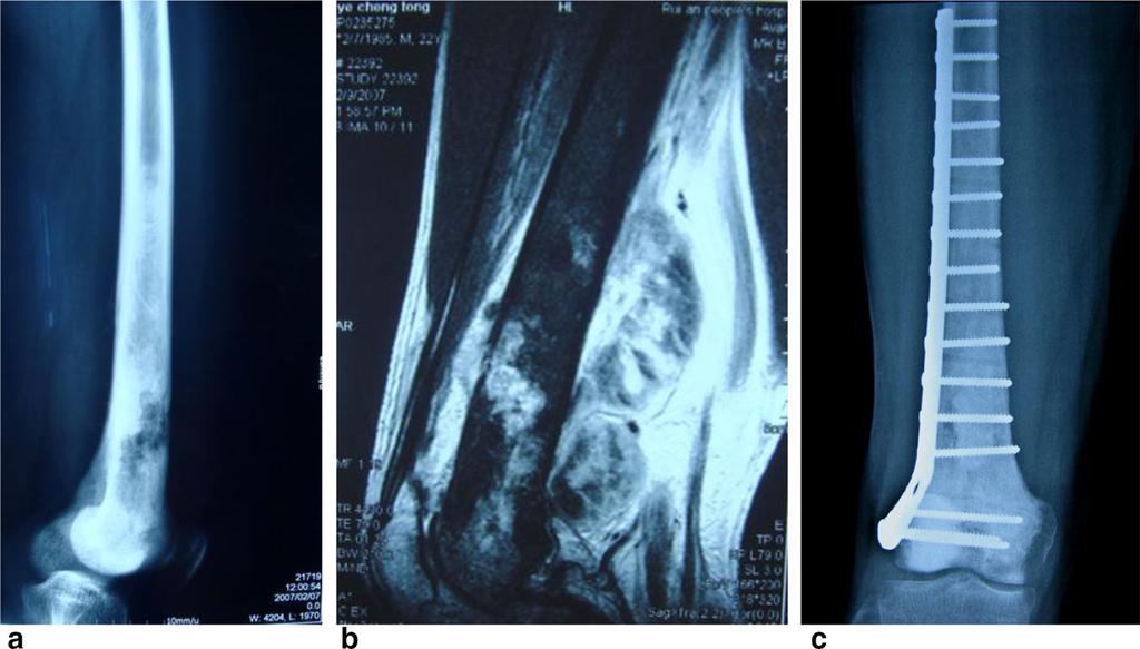 a X-ray film showing the lesion involved the majorlity of the femur, b MRI showing the huge tumor bulk, c X-ray film post-operation, the function is perfect at 10 years after surgery Authors