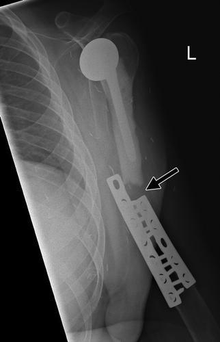 Bone graft fracture