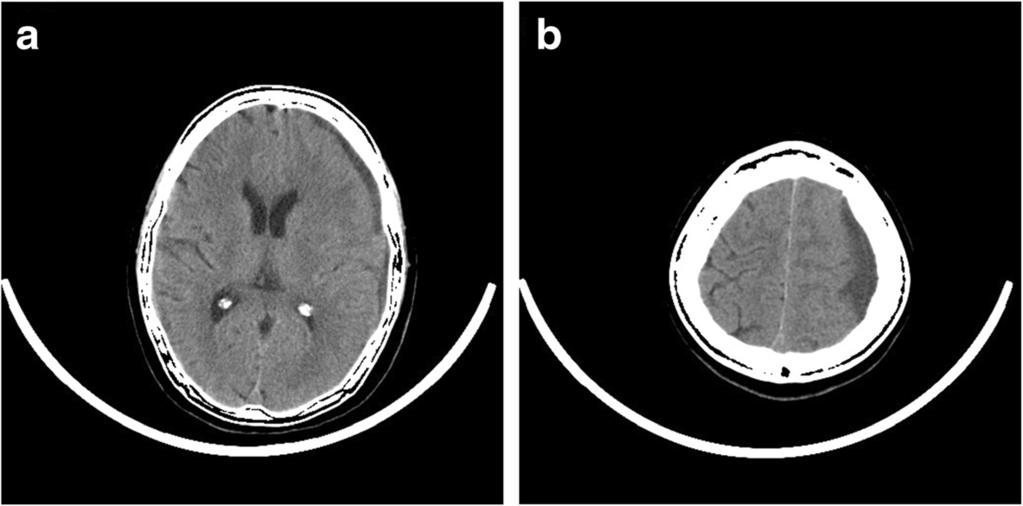 b CT suggested absorbed SDH of left parietal side in the first hospitalization a relationship with her first acute SDH which had been absorbed completely. Leukocyte count (153.