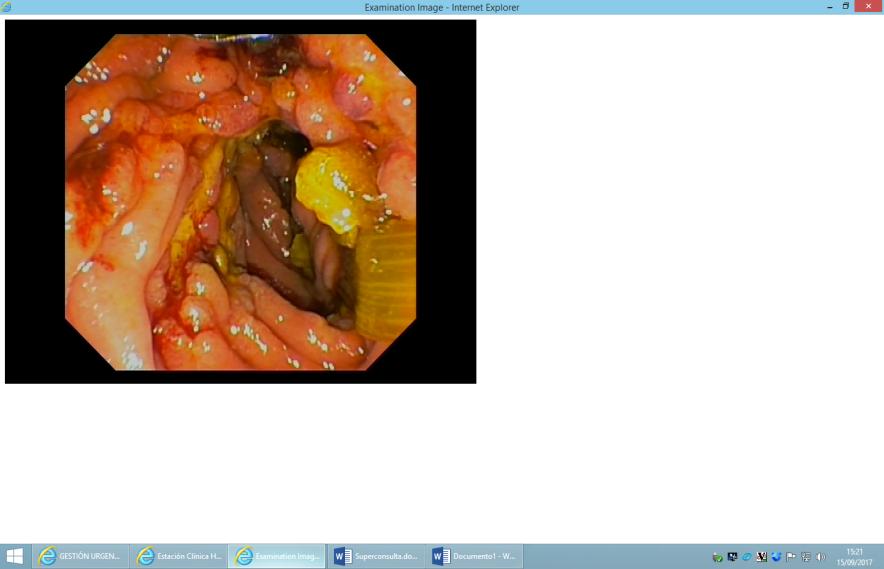 Fig. 2. ERCP and endoscopic images. A.
