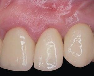 modification of the gingival biotype with Derma membrane Sex: