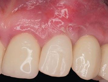 It is possible to observe the mucogingival correction made with