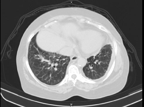 CT scan Jan 2014 showed resolution of pleural effusion and persistent hepatic nodular lesions unchanged from