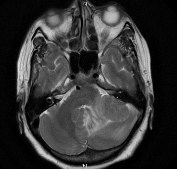 MRI Brain(9/11/2015)
