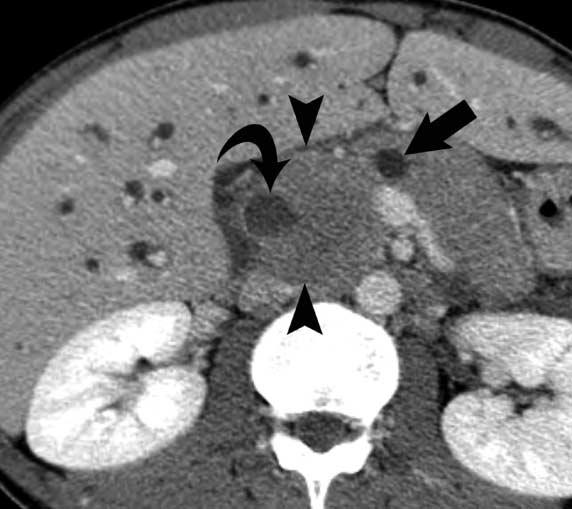 Tae Wook Heo, et al : Primary Pancreatic Lymphoma with Severe Dilatation of Pancreatic Duct enhancement (Fig. 1D).