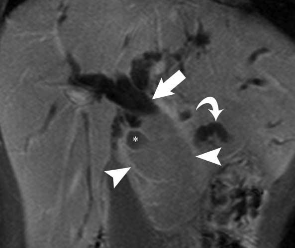 moderate dilatation of the pancreatic duct (arrow) and both intrahepatic bile ducts. B.