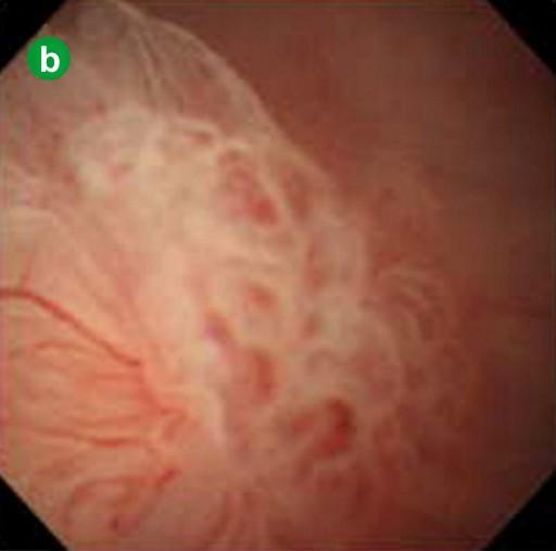 directly examine the lumen of the main pancreatic duct and the papillary tumor adjacent to the fistula (Figure 3d).