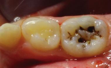 deciduous mandibular molars. Image 1.