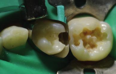 Mandibular primary molars with caries lesions.