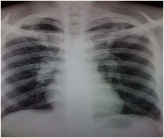 [Table/Fig 1] Chest X-ray: Dilatation of the pulmonary artery The patient gave a history of chest pain, six weeks prior to the onset of the present complaints.