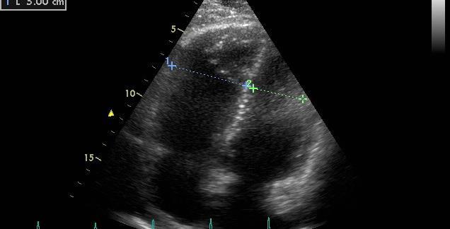 Typical echocardiographic image of PE involves the presence of three groups of criteria: 1.
