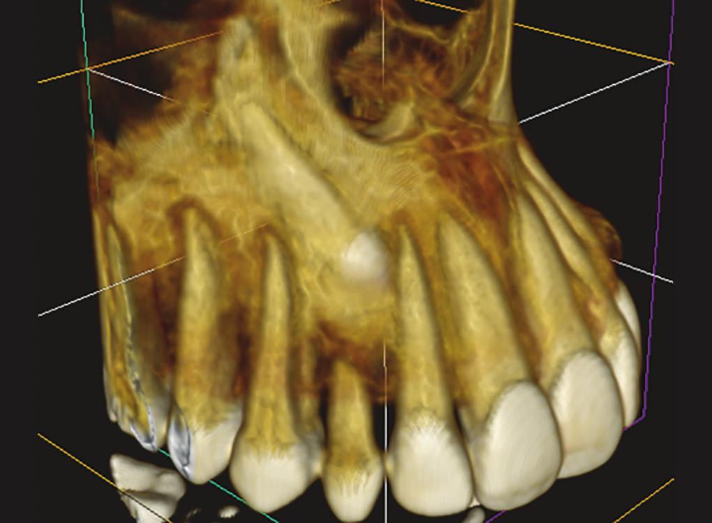 Komal N Prasad et al Fig. 1: The CBCT image of patient from which finite element models were derived from, showing palatally impacted canine Fig.