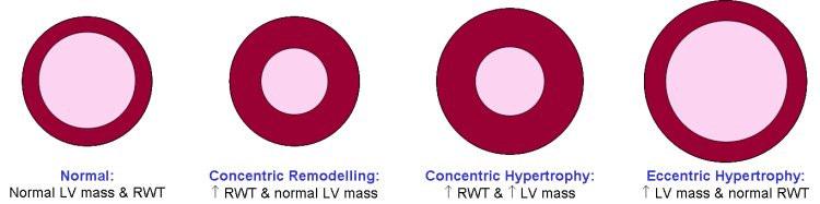 Patterns Of LVH LV geometry Concentric remodelling and concentric