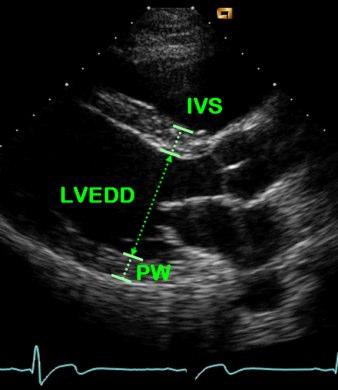 LVH assessment - ECHO Cardiologists report LV wall thickness