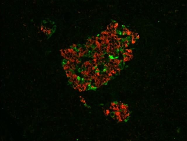 pancreatic mass Red = β-cells, stained