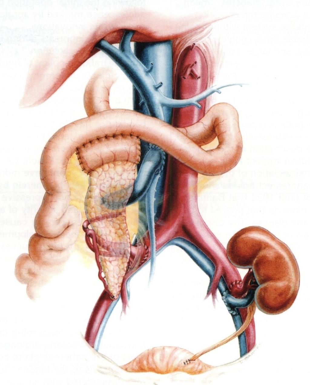 Pancreas transplantation Larsen.