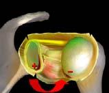 SUBLUXATION DISLOCATION (GII) (PANALOK) DISLOCATION/SUBLUXATION RATE 3,7 SUBLUXATION (PANALOK) 2000 SFA SYMPOSIUM ANNECY SHOULDER ANTERIOR CHRONIC