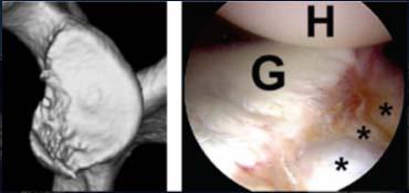 2006 : Glenoid Bone loss evaluation 2006 Open Iliac Crest Bone Graft (Eden