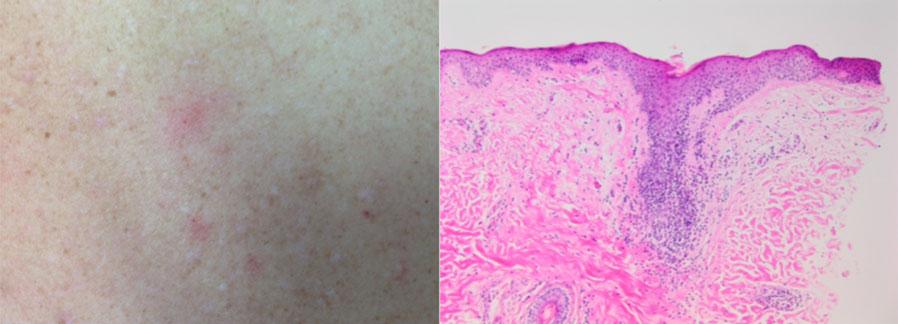 e54 LK Pitney et al. cases. This disparity in diagnostic rates led us to believe that there are significant barriers to the appropriate clinical and pathological recognition of acne necrotica.