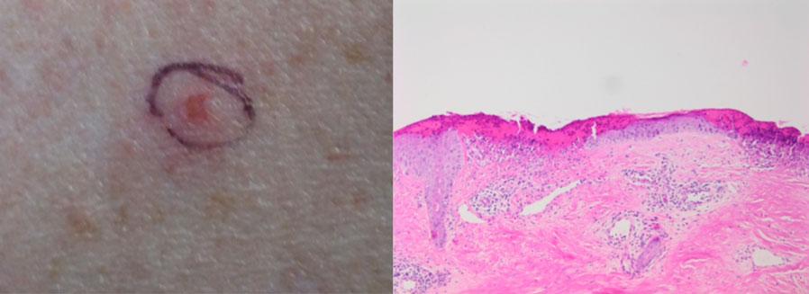 1), followed by superficial crusting overlying evolving confluent necrosis of the upper pilosebaceous unit and adjacent epidermis/dermis with neutrophils in the upper follicular and dermis 7 in early