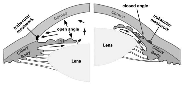 Open Angle vs Closed Angle Glaucoma Ach