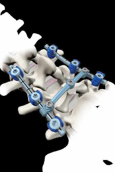 2 Vital Spinal Fixation System Surgical