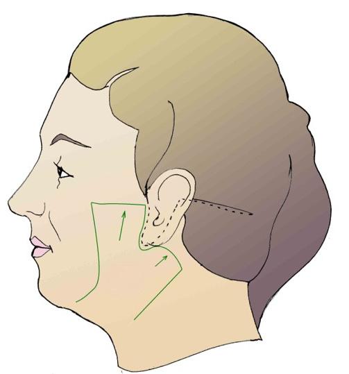 A facelift is the most effective way to reduce sagging in your face and neck.
