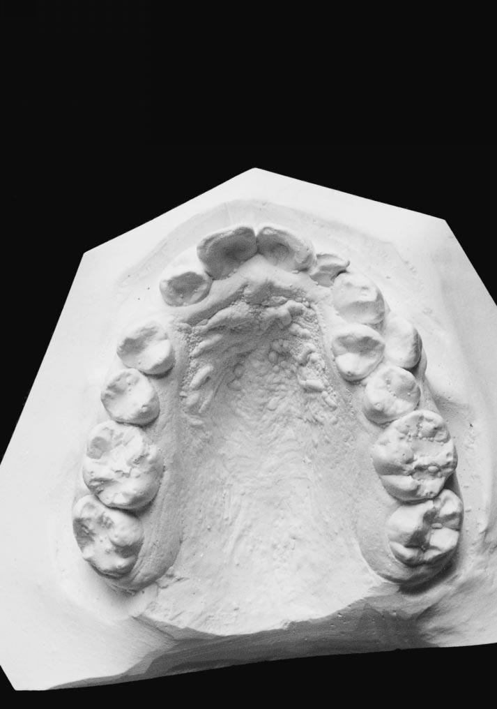 DENTAL ANOMALIES IN DOWN SYNDROME 295 FIGURE 3. Occlusal view of maxillary dental cast of a 17-year-old patient showing left Mx.C.