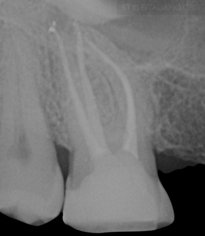 Fig. 11 Fig 11.- At the 5-year recall after the endodontic treatment, the tooth was asymptomatic, and functioning.