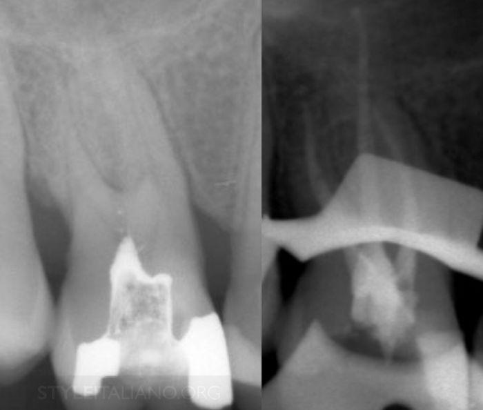 Case 2: A 53 year old man had localized pain in the maxillary right second molar and irradiated pain to the maxillary right zygoma.